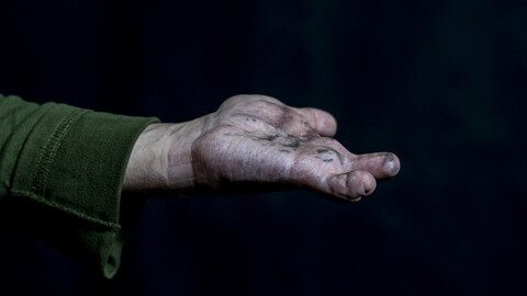 A raised human hand with three fingers injured and missing, and scars on the palm, against a black background.