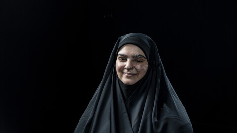 A smiling woman wearing a black veil sits against a black background. Her hands and face are visibly scarred.