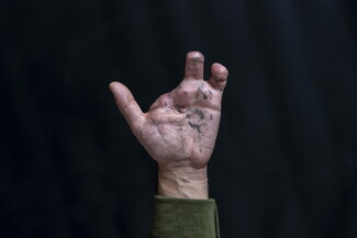 A raised human hand with three fingers injured and missing, and scars on the palm, against a black background.