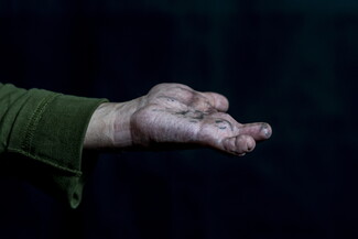 A raised human hand with three fingers injured and missing, and scars on the palm, against a black background.
