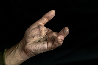 A raised human hand with three fingers injured and missing, and scars on the palm, against a black background.